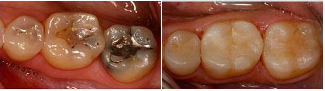 Metal Free Fillings