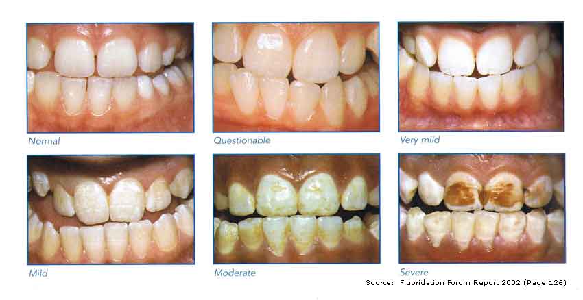 high fluoride toothpaste side effects